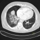 Alveolar hemorrhage: CT - Computed tomography